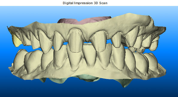 Digital Dental Impressions: Precision in Oral Care